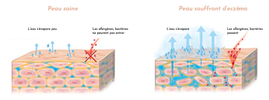 photo comparative d'une peau saine et d'une peau qui souffre d'eczéma