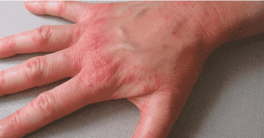 eczéma sur les mains