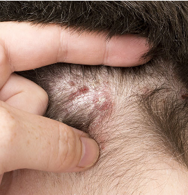 eczéma dans les cheveux