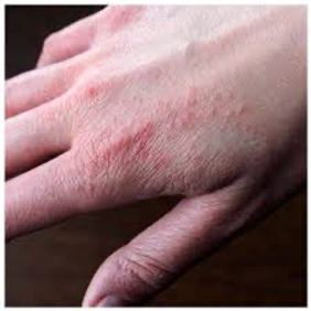 zoom eczéma sur les mains