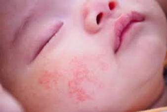 photo d'un bébé ayant de l'eczéma sur le visage