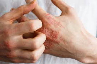 photo d'une personne qui se gratte les mains à cause de l'eczéma